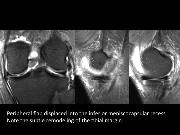 Figure 4 for case posterior cruciate ligament ( RID2784 )